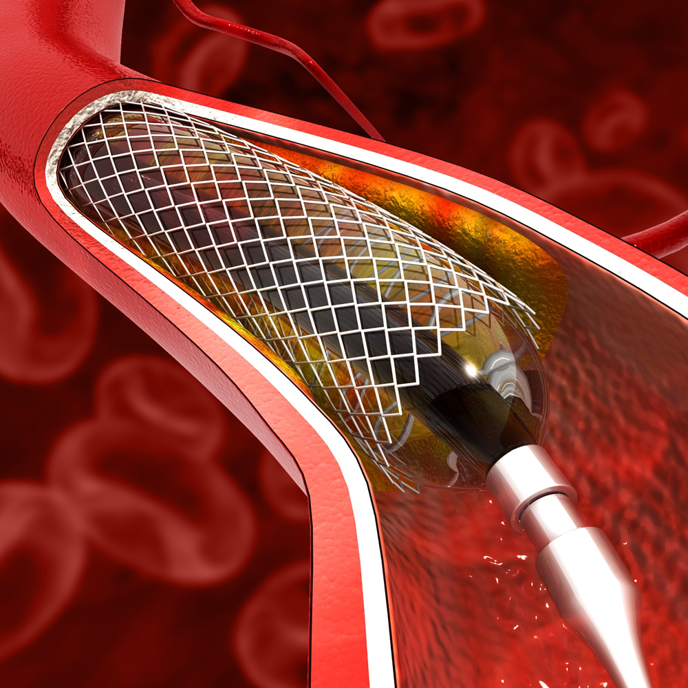 angioplasty