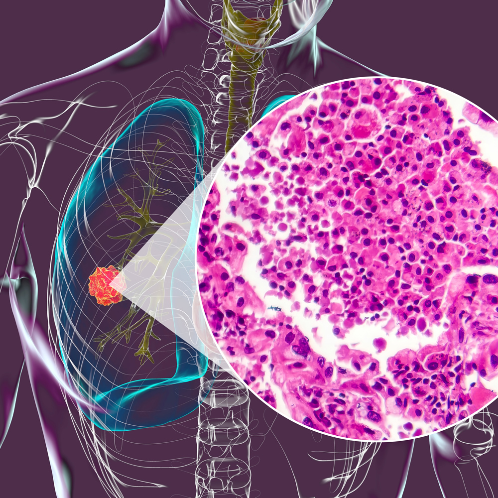 biopsy